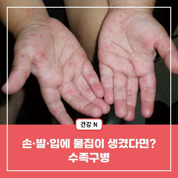 [건강N] 손·발·입에 물집이 생겼다면? 수족구병